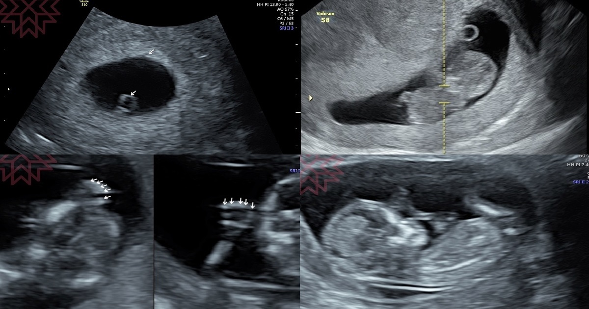 《懷孕》0-12週，地獄般的懷孕初期、各項檢查、初期保養
